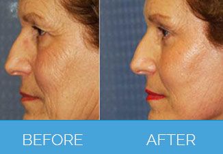 facelift