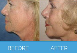 facelift
