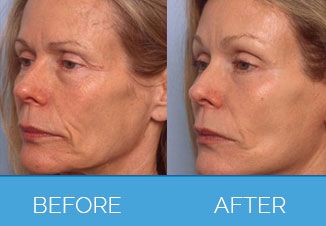 facelift