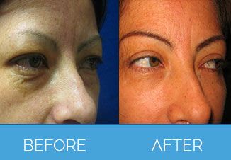 Eyebag Removal - Blepharoplasty Surgery