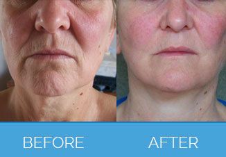facelift