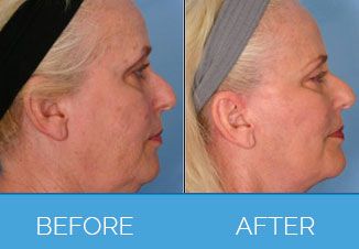 facelift