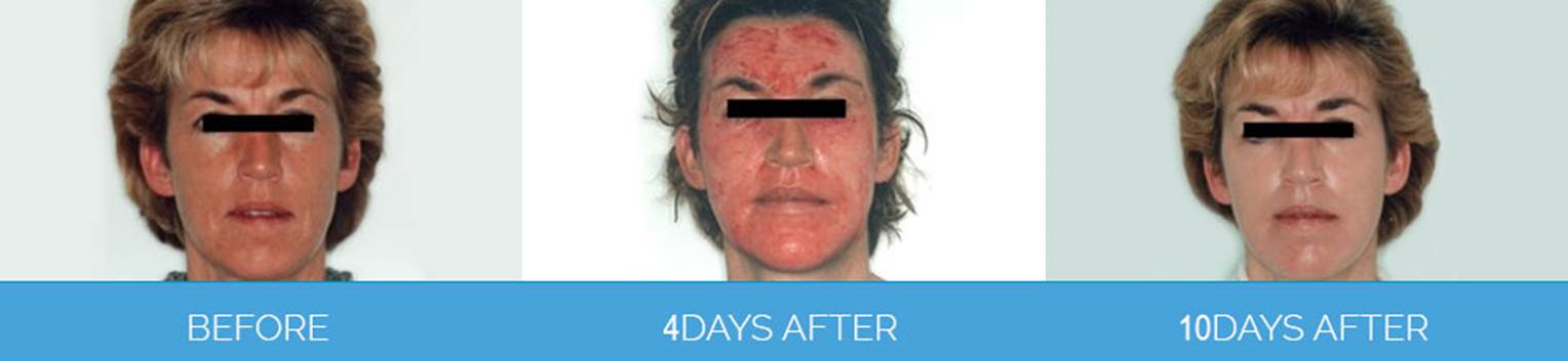 Laser Skin Rejuvenation1