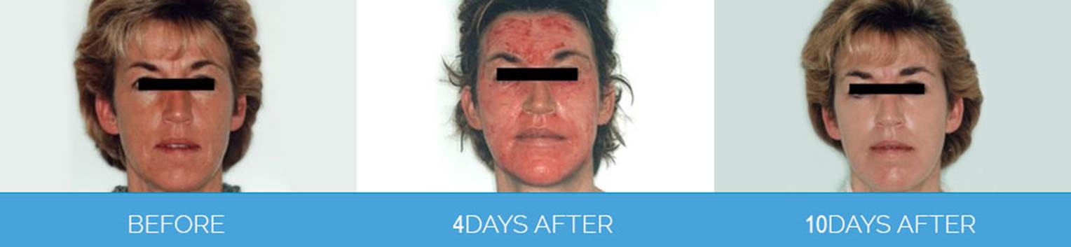 Laser Skin Rejuvenation Before and After