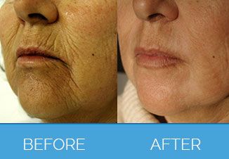 Laser Skin Rejuvenation2
