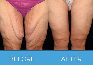 Thigh Lift Surgery