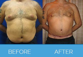 Male Tummy Tuck2