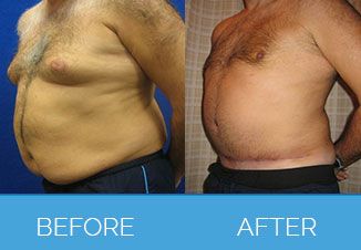 Before and After Male Tummy Tuck1