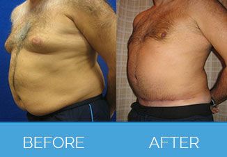 Male Tummy Tuck1