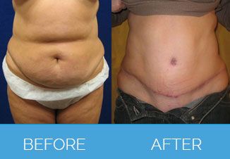 Tummy Tuck Before After 1