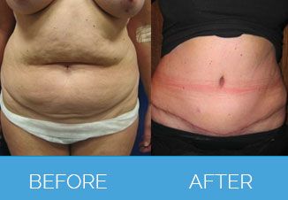 Tummy Tuck Before After 2