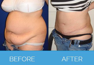 Tummy Tuck Before After 3