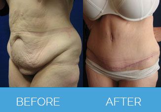Tummy Tuck Before After 4