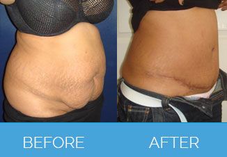 Tummy Tuck Before After 5