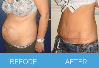 Tummy Tuck Before After 6
