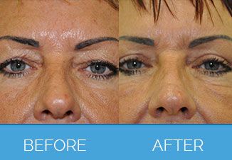 Upper Eyelid Surgery2