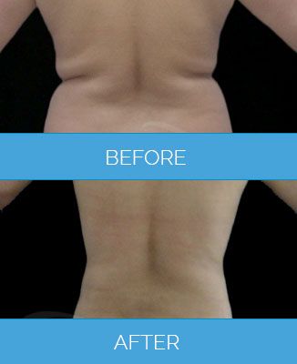 Vaser-Liposuction1.2