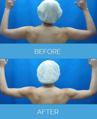 Vaser-Liposuction1.3