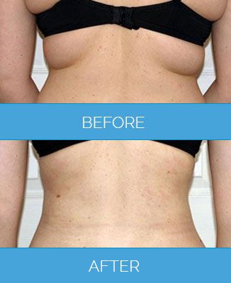 Vaser-Liposuction1.4