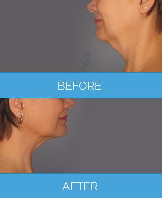 Vaser-Liposuction1.5