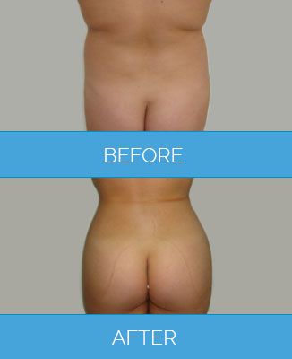 Vaser-Liposuction1.6