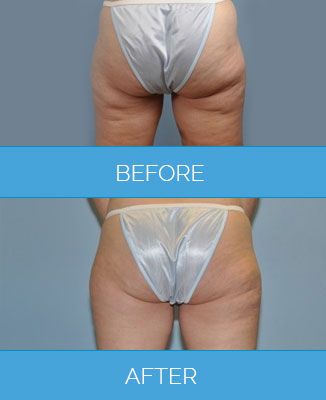 Vaser-Liposuction1.7