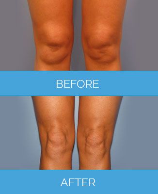 Vaser-Liposuction1.8