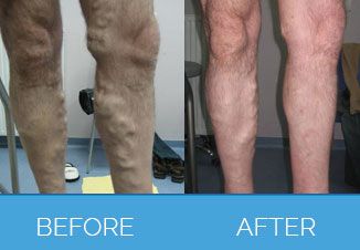 Vericose-Vein