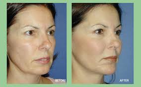 Cheek implants