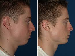Chin implant