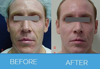 chemical peel2