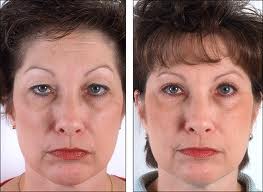 blepharoplasty