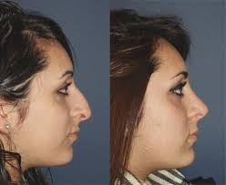 rhinoplasty