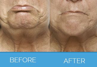 Wrinkle Smoothing7