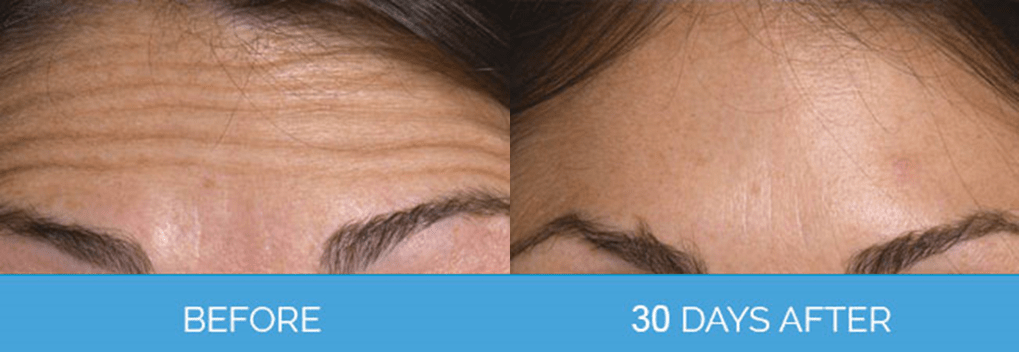 Wrinkle Smoothing before & after1