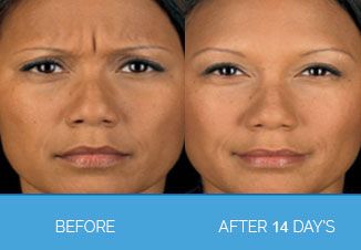 Wrinkle Smoothing9