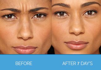 Wrinkle Smoothing3