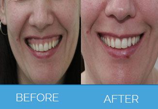 Wrinkle Smoothing5