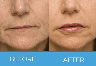 Dermal Fillers before and after