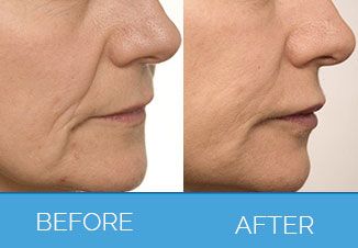 Dermal Fillers before and after