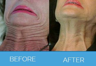 Wrinkle Smoothing6