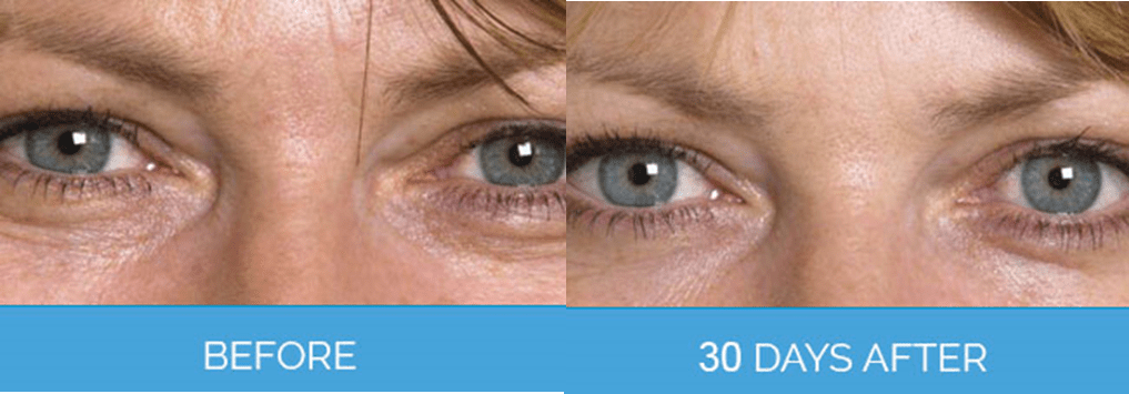 Wrinkle Smoothing2