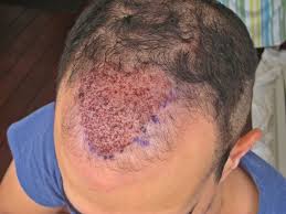 FUE hair transplant