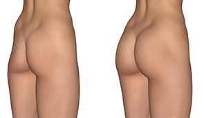 liposuction to remove stubborn fat
