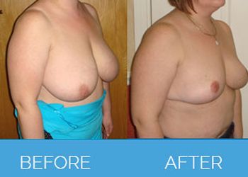 breast reduction2