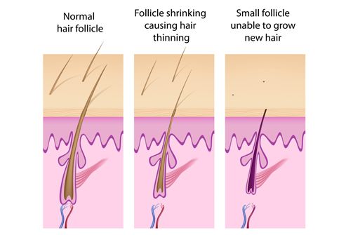 Female Hair Transplant
