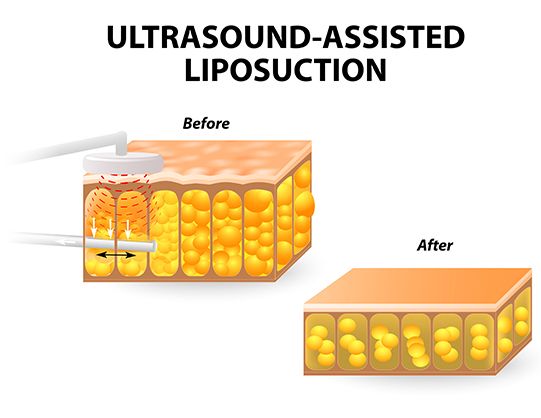 Male Vaser Liposuction | Vaser Lipo Areas
