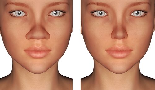 rhinoplasty