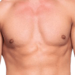 Male Tummy Tuck