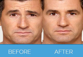 Brotox treatment before & after